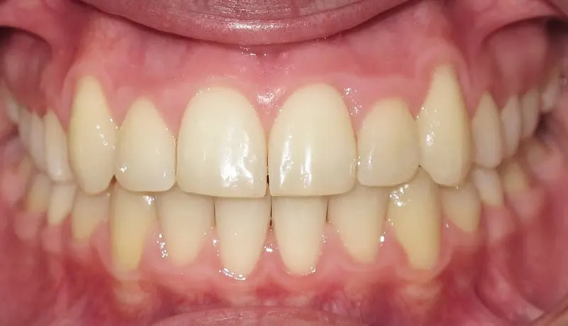 Orthodontic case 1 after treatment