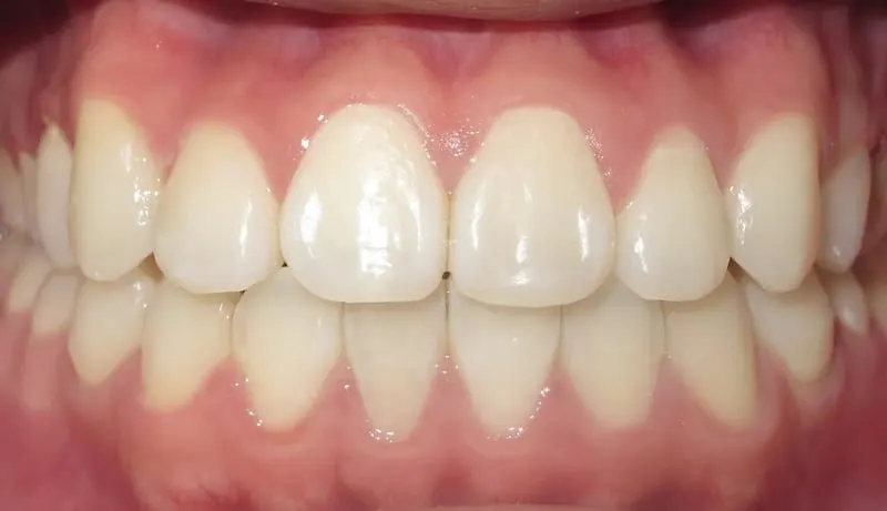 Orthodontic case 2 after treatment