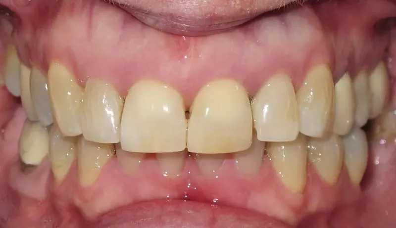 Orthodontic case 3 after treatment