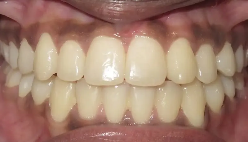 Orthodontic case 4 after treatment
