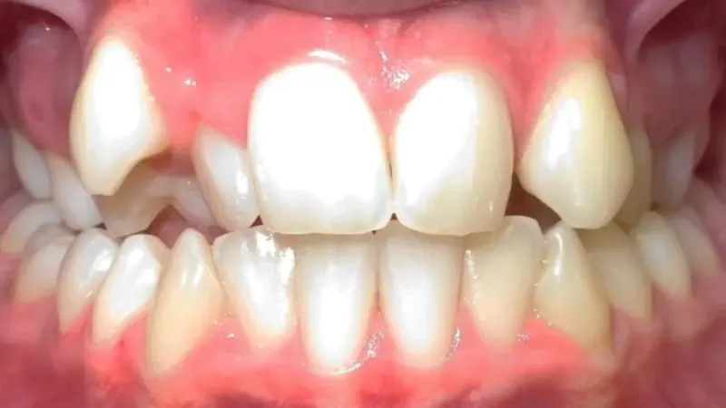 Orthodontic case 1 before treatment