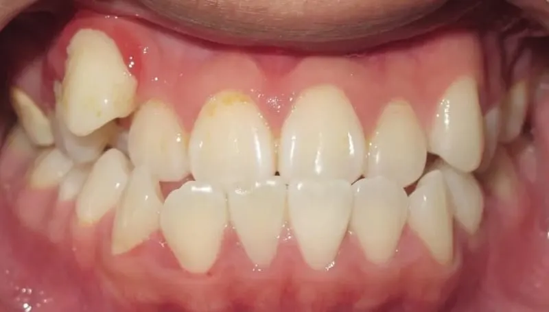 Orthodontic case 2 before treatment