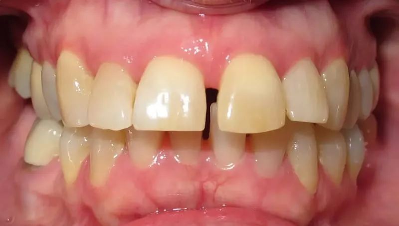 Orthodontic case 3 before treatment