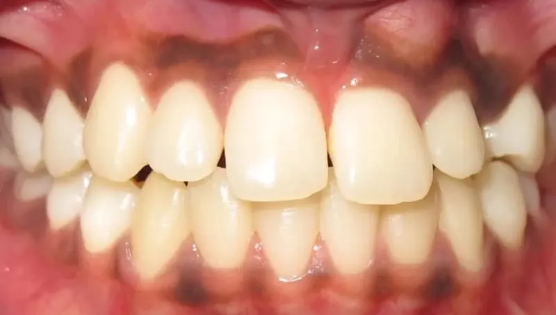 Orthodontic case 4 before treatment