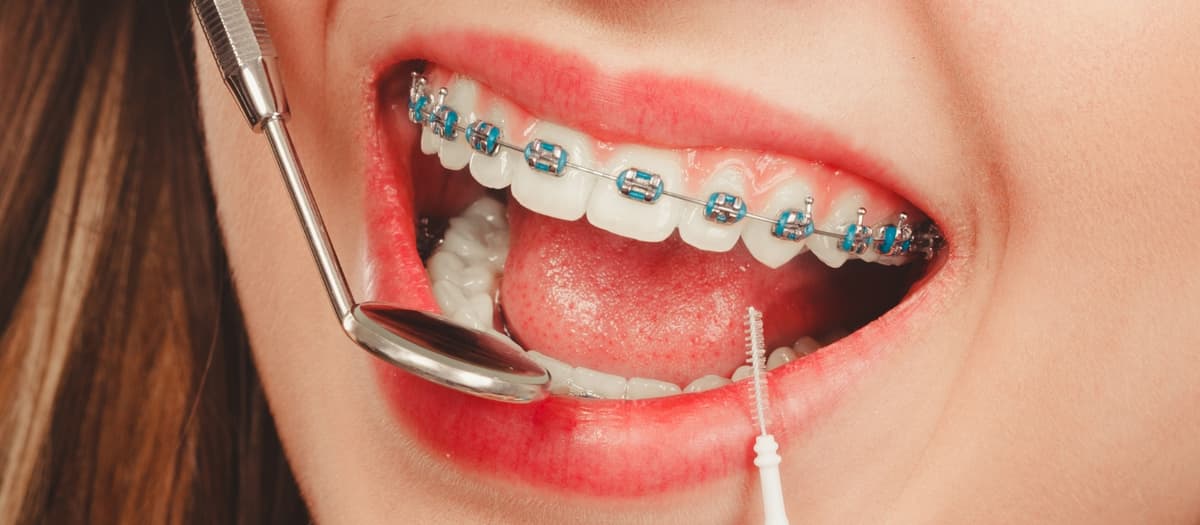 Clear Braces in San Antonio, TX | Cochran Orthodontics
