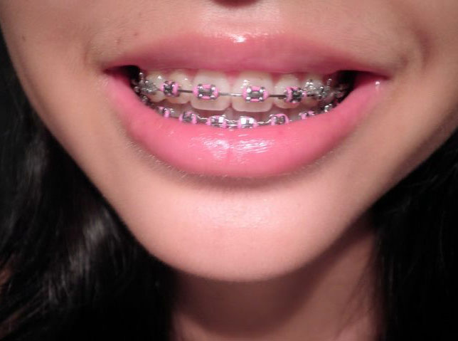 Metal Braces  San Antonio Orthodontics