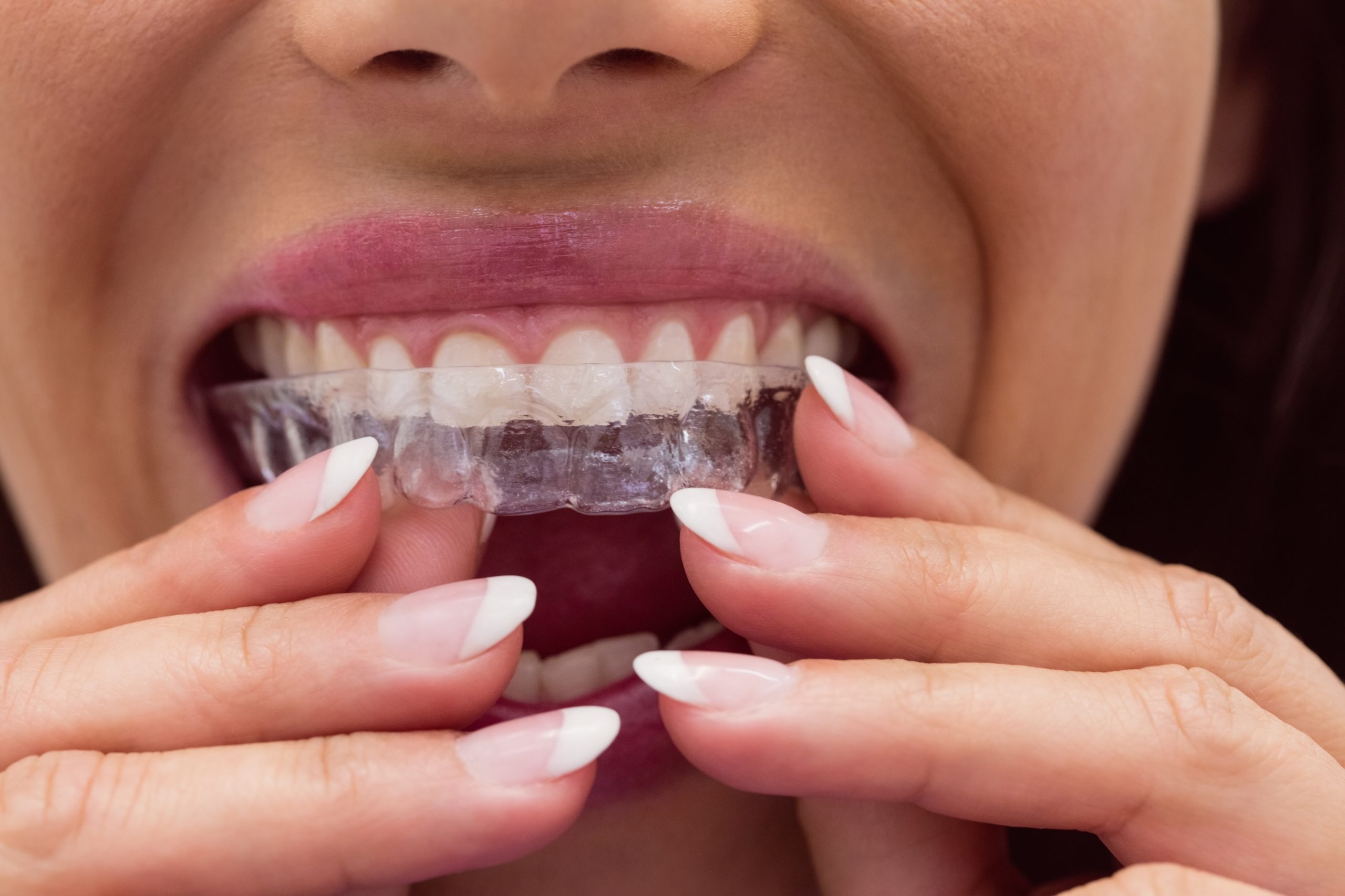 Invisalign for adult