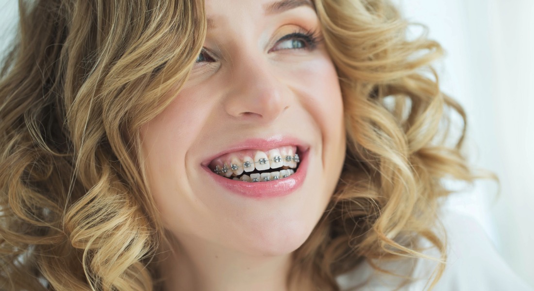 Top Metal Braces