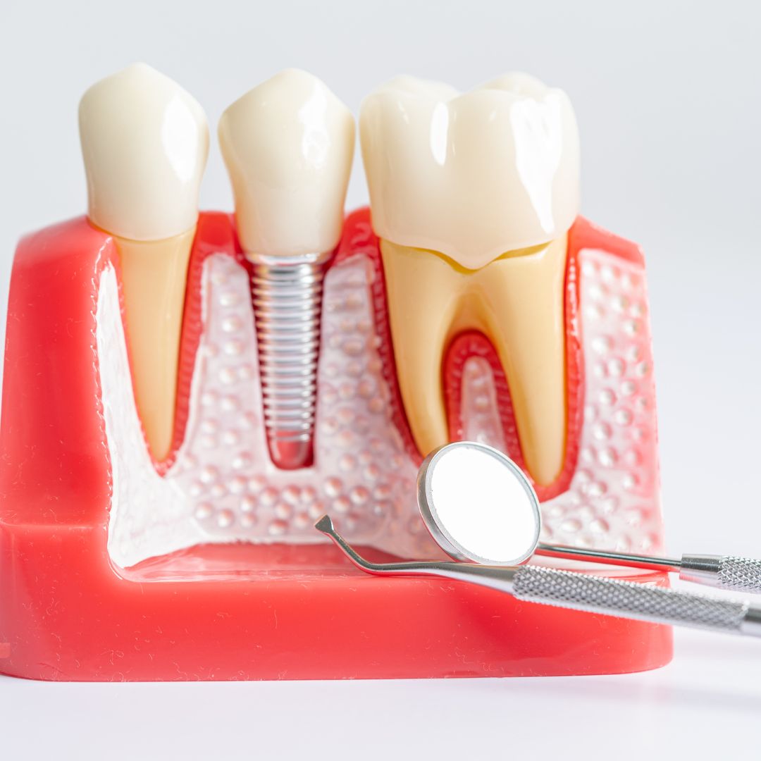 Affordable dental implants