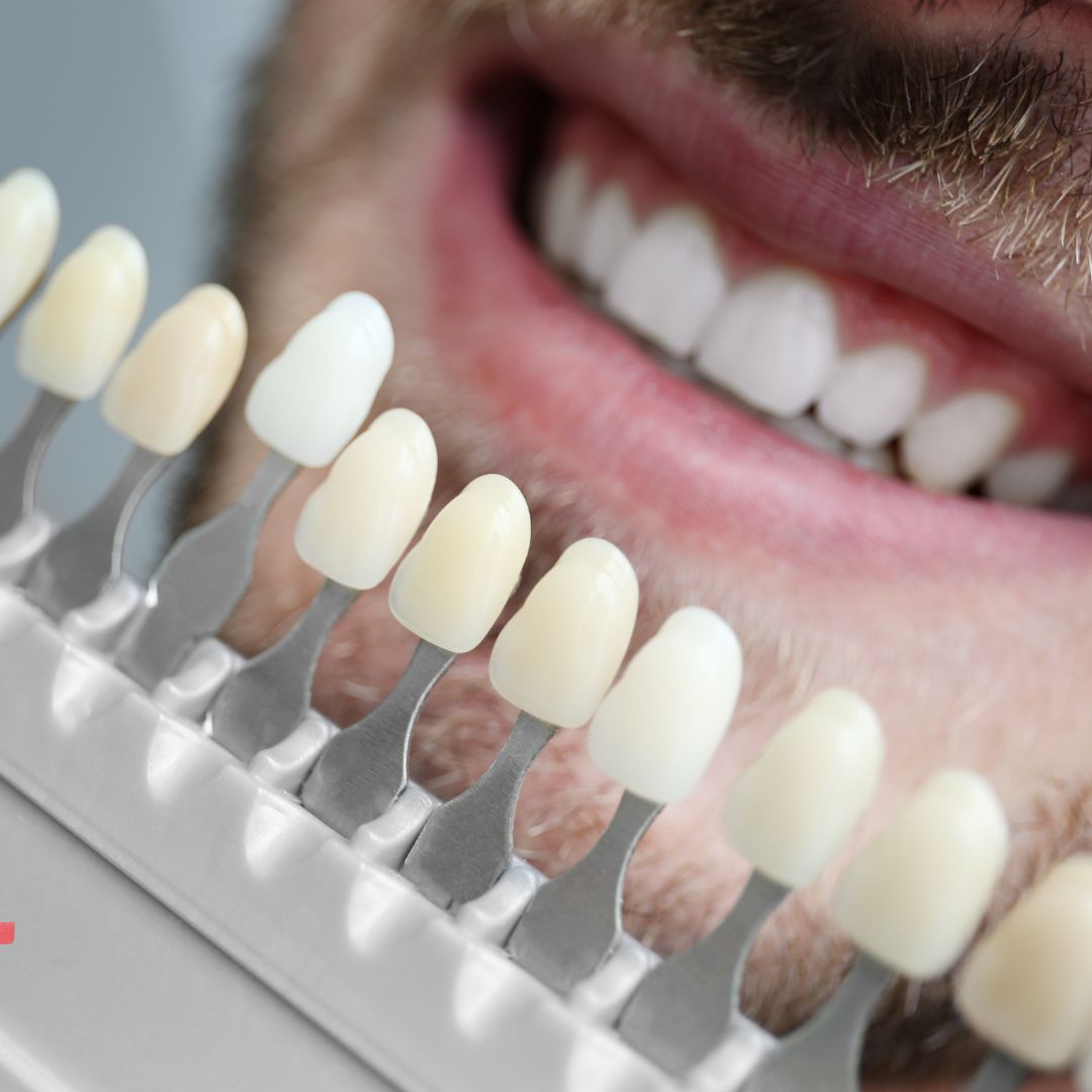 Dental veneers