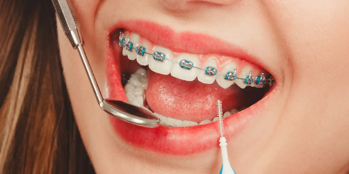 Adult Braces San Antonio