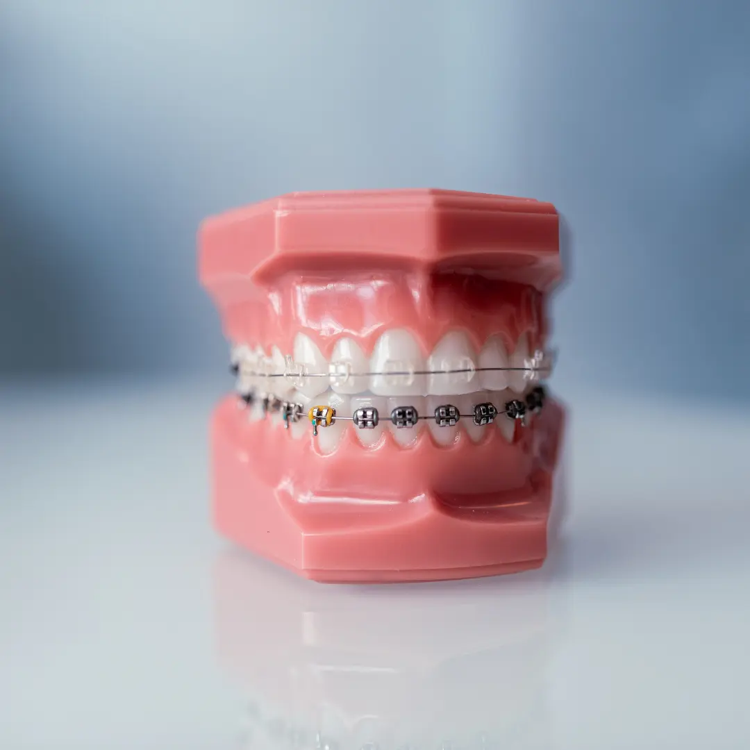 Clear braces vs metal