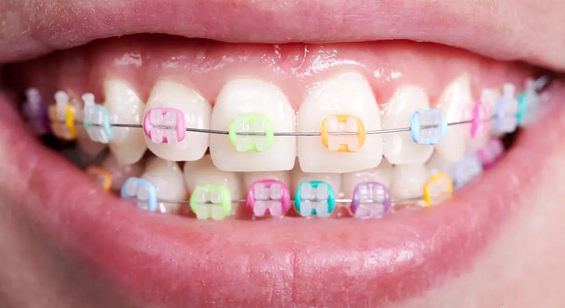 Color braces for teeth